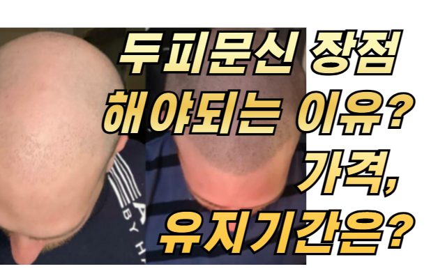 두피문신 장점 해야되는 이유? 가격, 유지기간은?